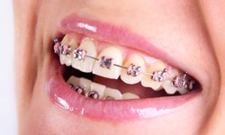Types of braces - traditional metal braces