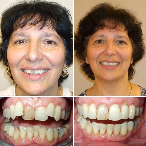 Before and After Photos from Premier Orthodintics & Dental Specialists Photo 5