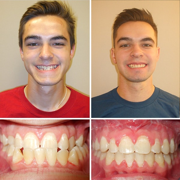 Before and After Photos from Premier Orthodintics & Dental Specialists Photo 8