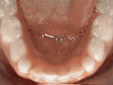 non-braces-treatment-after Premier Orthodontics & Dental Specialists in Elmhurst Downers Grove, IL