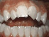 openbite-before Premier Orthodontics & Dental Specialists in Elmhurst Downers Grove, IL