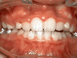 phase-1-after Premier Orthodontics & Dental Specialists in Elmhurst Downers Grove, IL
