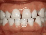 spacing-of-teeth-before Premier Orthodontics & Dental Specialists in Elmhurst Downers Grove, IL