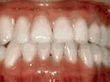 underbite-after Premier Orthodontics & Dental Specialists in Elmhurst Downers Grove, IL