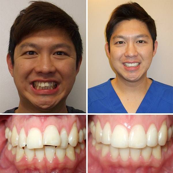 Before and after treatment Premier Orthodontics & Dental Specialists in Elmhurst Downers Grove, IL