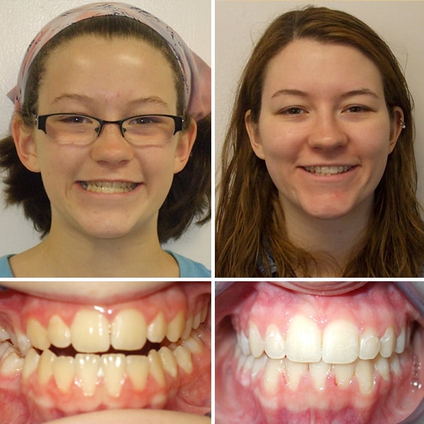 Before and after treatment Premier Orthodontics & Dental Specialists in Elmhurst Downers Grove, IL