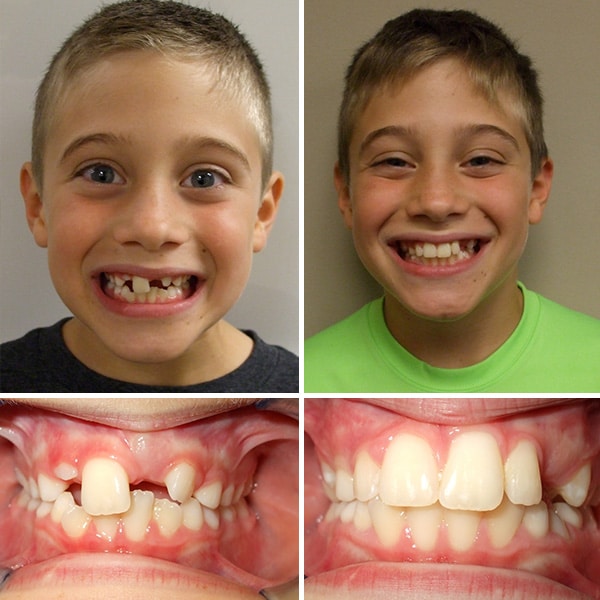 Before and after treatment Premier Orthodontics & Dental Specialists in Elmhurst Downers Grove, IL