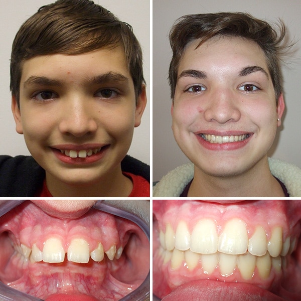 Before and after treatment Premier Orthodontics & Dental Specialists in Elmhurst Downers Grove, IL
