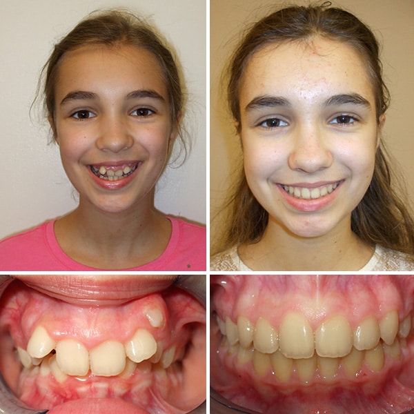 Before and after treatment Premier Orthodontics & Dental Specialists in Elmhurst Downers Grove, IL