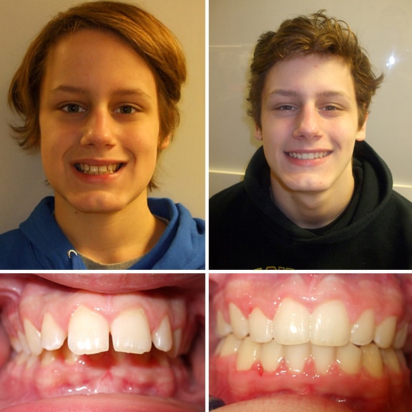 Before and after treatment Premier Orthodontics & Dental Specialists in Elmhurst Downers Grove, IL