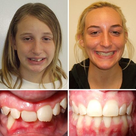 Before and after at Premier Orthodontics & Dental Specialists in Elmhurst Downers Grove, IL