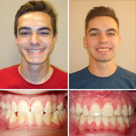 Before and after treatment Premier Orthodontics & Dental Specialists in Elmhurst Downers Grove, IL